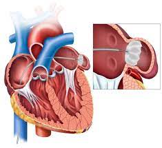 Transforming Atrial Fibrillation Treatment: The Watchman Implant