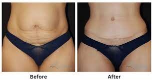 Miami’s Reputed Tummy Tuck Surgeons