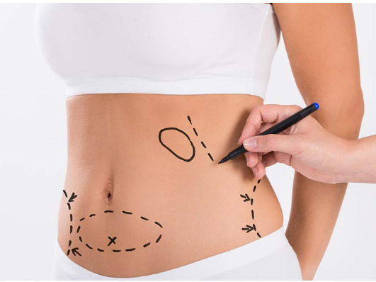 Be Bold, Be Beautiful: Your Miami Tummy Tuck Journey Begins
