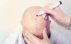 Factors That Affect Hair Transplant Cost: A Comprehensive Guide