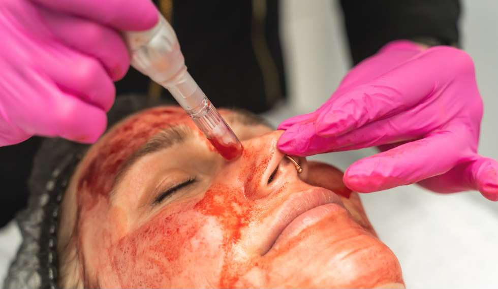 How Vampire Facials Improve Skin Health